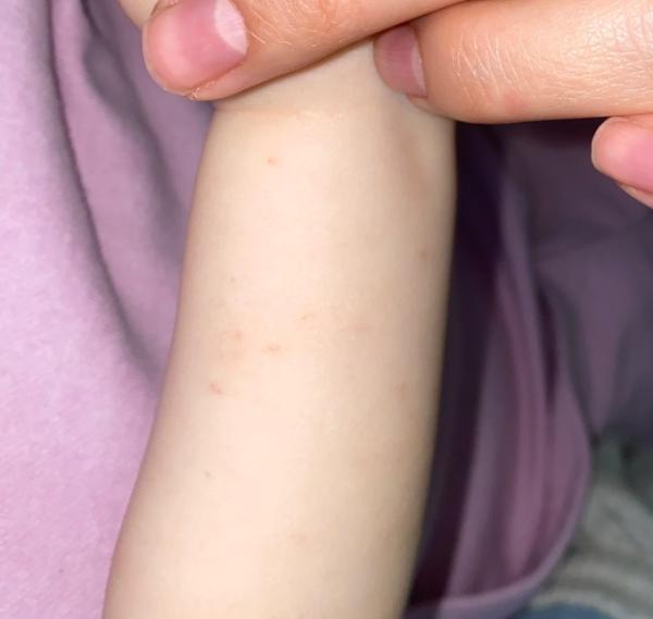 Bild zu Wieder hautprobleme - Baby Forum - Allgemeine Themen