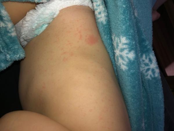 Bild zu Ausschlag 3 Tages Fieber? - Baby Forum - Allgemeine Themen