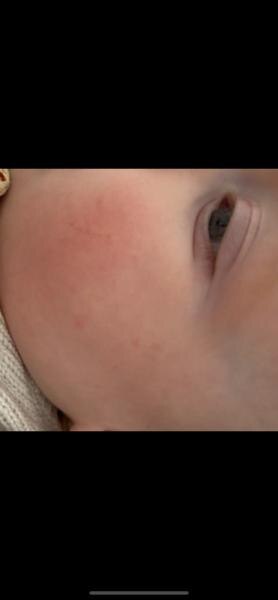 Bild zu Herpes 6 Monate altes Baby - Baby Forum - Allgemeine Themen