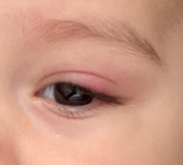Bild zu Auge Lid Rot und Angeschwollen - Baby Forum - Allgemeine Themen