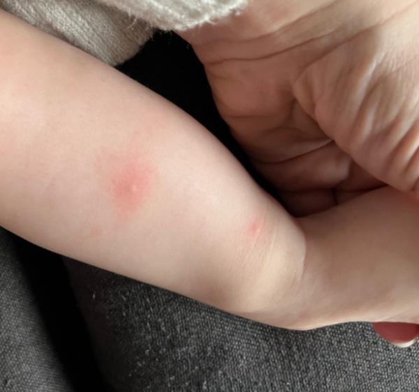 Bild zu Komische Stiche am Bein, was könnte das sein? - Baby Forum - Allgemeine Themen
