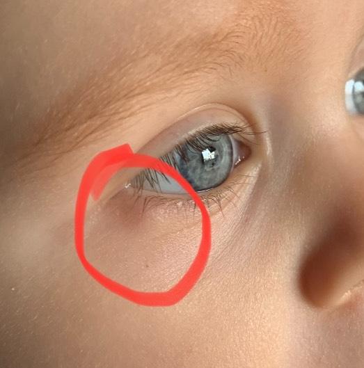 Bild zu Knoten am unteren Augenlid - Baby Forum - Allgemeine Themen
