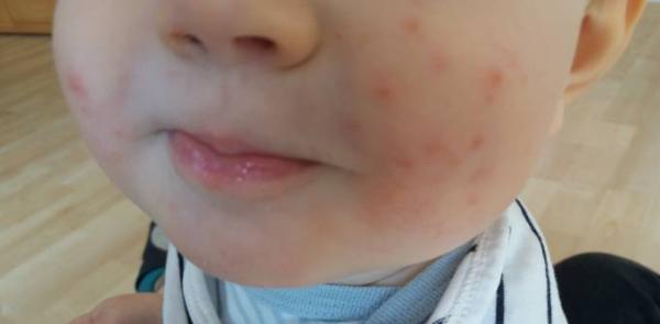 Bild zu Eitrige Pickel- Baby-Akne? - Baby Forum - Allgemeine Themen