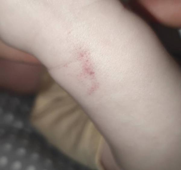 Bild zu Komischer Fleck auf der hand - Baby Forum - Allgemeine Themen