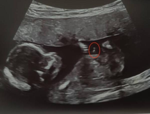 Bild zu Geschlecht oder Nabelschnur - Baby Forum - Allgemeine Themen