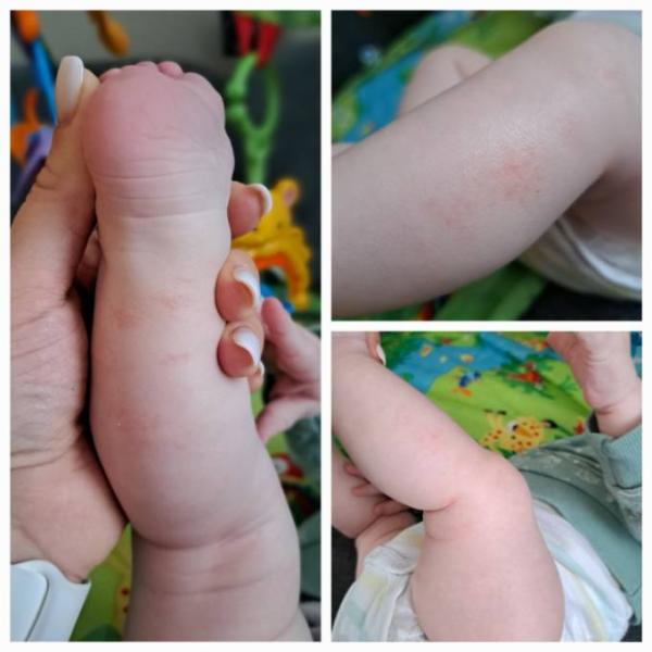 Bild zu Neurodermitis? - Baby Forum - Allgemeine Themen