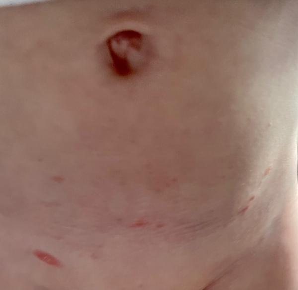 Bild zu Rote Flecken am Bauch und Windelbereich - Baby Forum - Allgemeine Themen