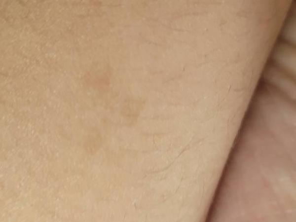 Bild zu Pigmentflecken beim Kind - Baby Forum - Allgemeine Themen