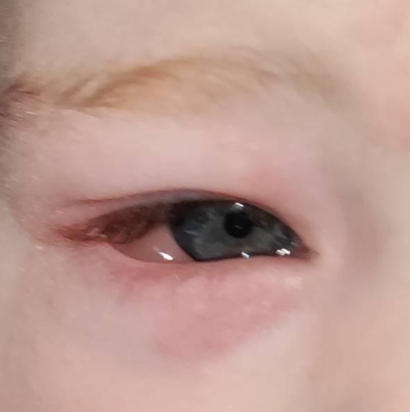 Bild zu Allergie? - Baby Forum - Allgemeine Themen
