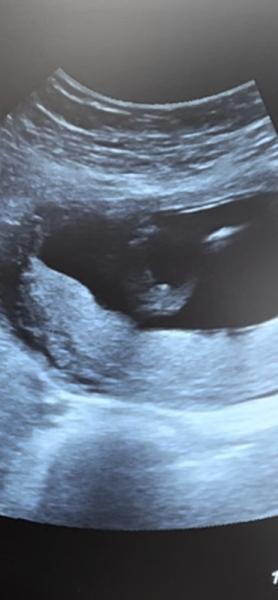 Bild zu Schwanger! Junge oder Mädchen was seht ihr ? - Baby Forum - Allgemeine Themen