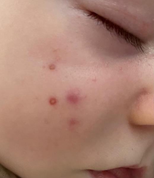 Bild zu Baby 19 Wochen / Probleme mit Pickel - Baby Forum - Allgemeine Themen