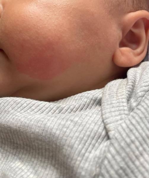 Bild zu Roter Fleck auf Backe - Baby Forum - Allgemeine Themen