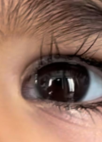 Bild zu Sohn 14 Monate Iris Trübung - Baby Forum - Allgemeine Themen