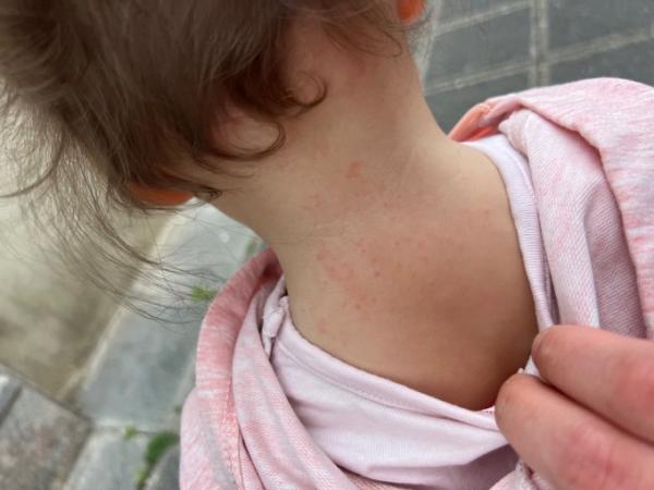 Bild zu Kleine rote Flecken am Nacken Kind 1 J. - Baby Forum - Allgemeine Themen