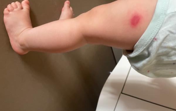 Bild zu Entzündeter Insektenstich - Baby Forum - Allgemeine Themen