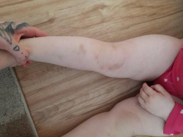 Bild zu Kleinkind blaue flecke - Baby Forum - Allgemeine Themen