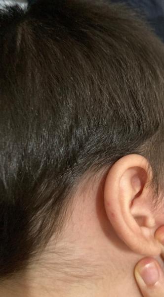 Bild zu Bitte um schnelle Hilfe 😩. Windpocken? - Baby Forum - Allgemeine Themen