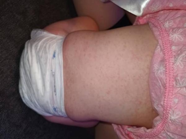 Bild zu 3Tage Fieber - Baby Forum - Allgemeine Themen