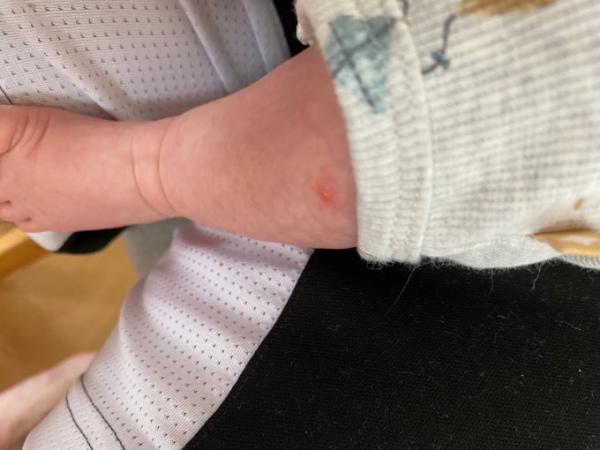 Bild zu Ausschlag Baby 5 Wochen alt - Baby Forum - Allgemeine Themen