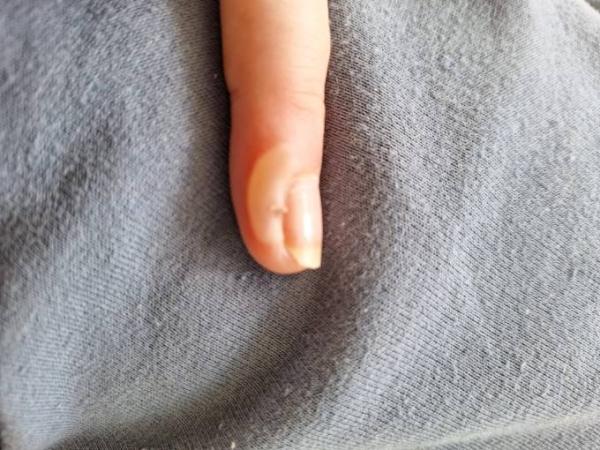 Bild zu Nietnagel Entzündung - Baby Forum - Allgemeine Themen