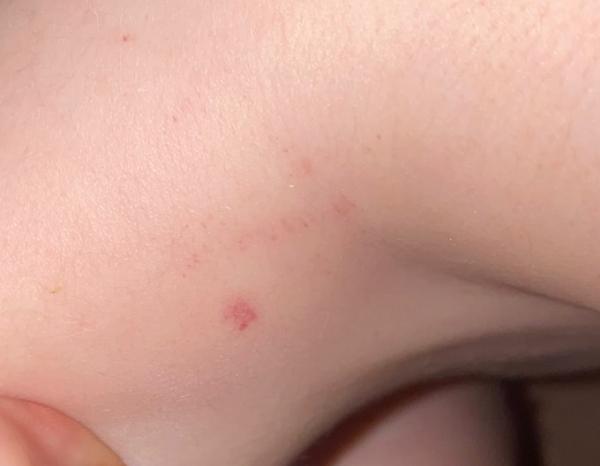 Bild zu Was kann es sein? Rote Hautstellen - Baby Forum - Allgemeine Themen