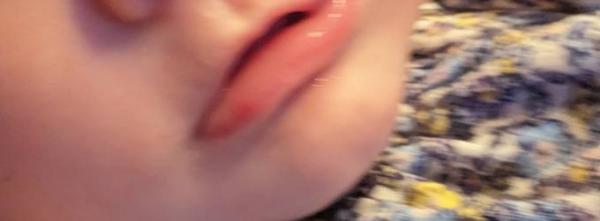 Bild zu Roter "Pickel" an der Lippe - Baby Forum - Allgemeine Themen