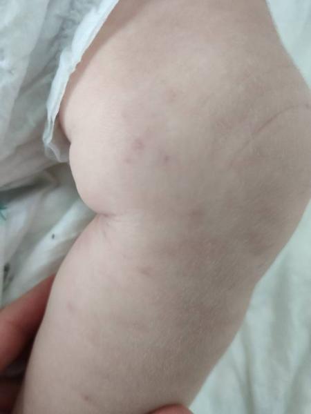 Bild zu kleine Punkte an den Beinen - Baby Forum - Allgemeine Themen