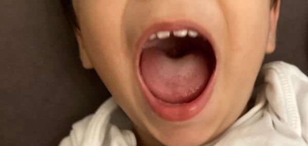 Bild zu Weißer Belag auf der Zunge Pilz ? - Baby Forum - Allgemeine Themen