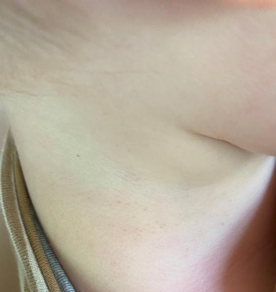Bild zu Petechien? - Baby Forum - Allgemeine Themen