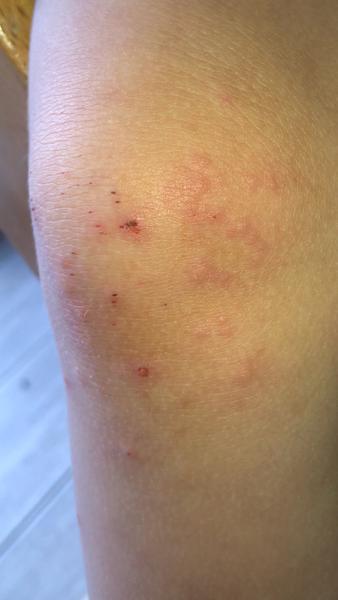 Bild zu Pusteln Knie und Hand, Kind 2 Jahre - Baby Forum - Allgemeine Themen