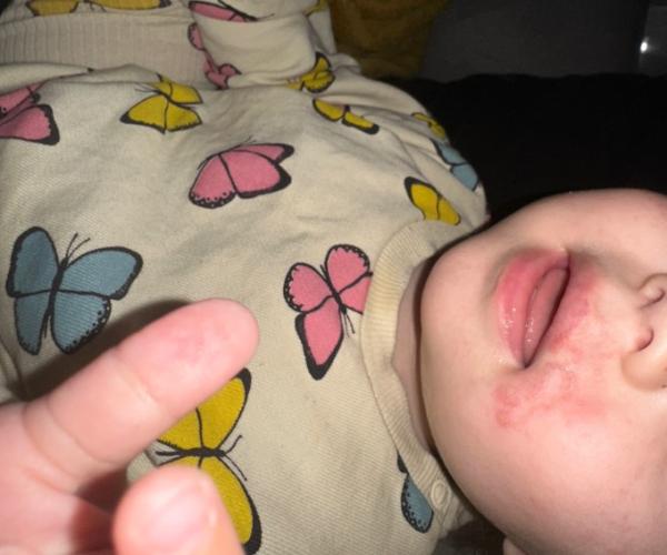 Bild zu Baby hat rötung am Mundrand - Baby Forum - Allgemeine Themen