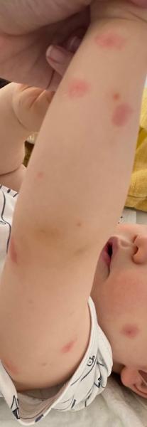 Bild zu Hilfe - Stiche / Bisse - Baby Forum - Allgemeine Themen