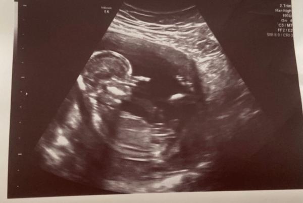 Bild zu Ultraschall Bild - Baby Forum - Allgemeine Themen