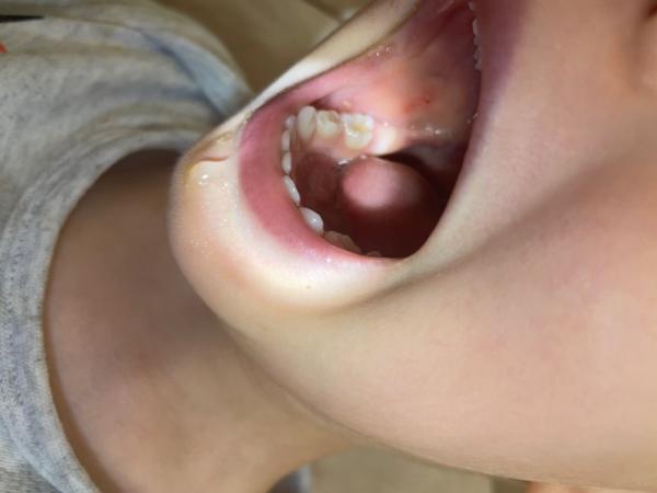 Bild zu Zähne - Anomalie? - Baby Forum - Allgemeine Themen