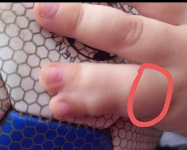 Bild zu Angewachsene Finger - Baby Forum - Allgemeine Themen