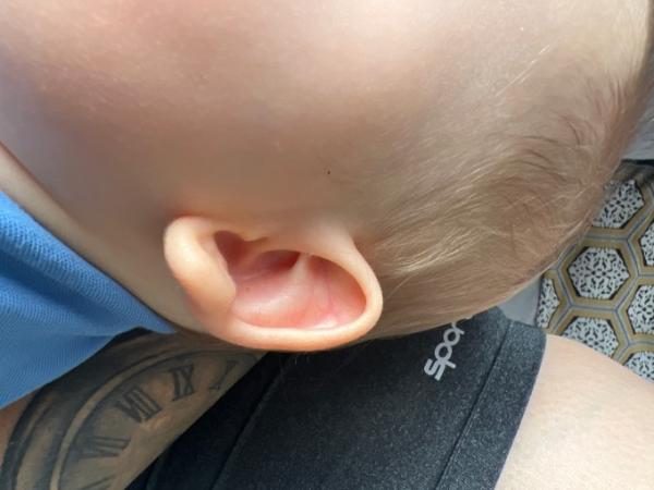 Bild zu Abstehendes Ohrläppchen - Baby Forum - Allgemeine Themen