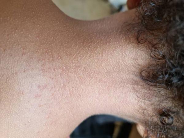 Bild zu Allergische Reaktion?! - Baby Forum - Allgemeine Themen