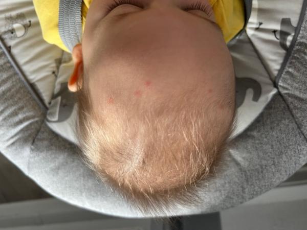 Bild zu Rote punkte - Baby Forum - Allgemeine Themen