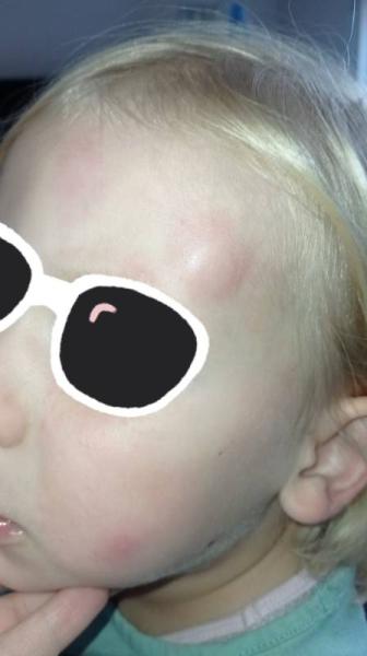 Bild zu Plötzlich dicke Beule auf der Stirn - Baby Forum - Allgemeine Themen
