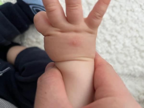 Bild zu Pickel oder Warze - Baby Forum - Allgemeine Themen