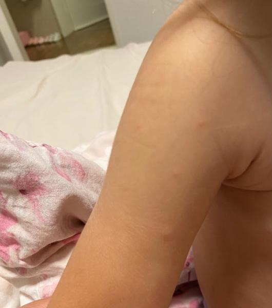 Bild zu Vereinzelnder farblose pickel - Baby Forum - Allgemeine Themen