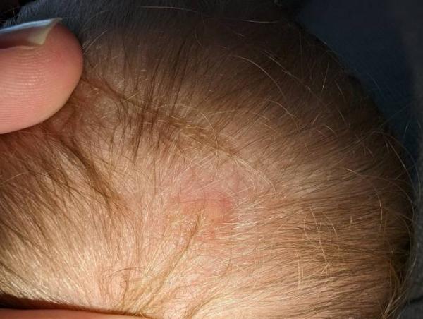 Bild zu Seltsame Stellen am Kopf - Baby Forum - Allgemeine Themen