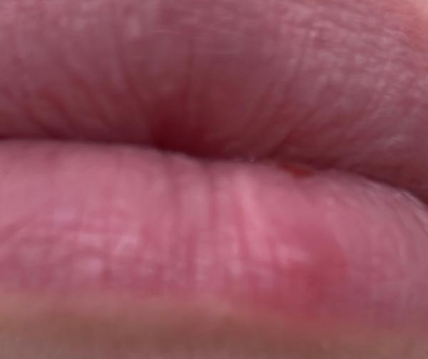 Bild zu Fieberblase/Lippenherpes - Baby Forum - Allgemeine Themen