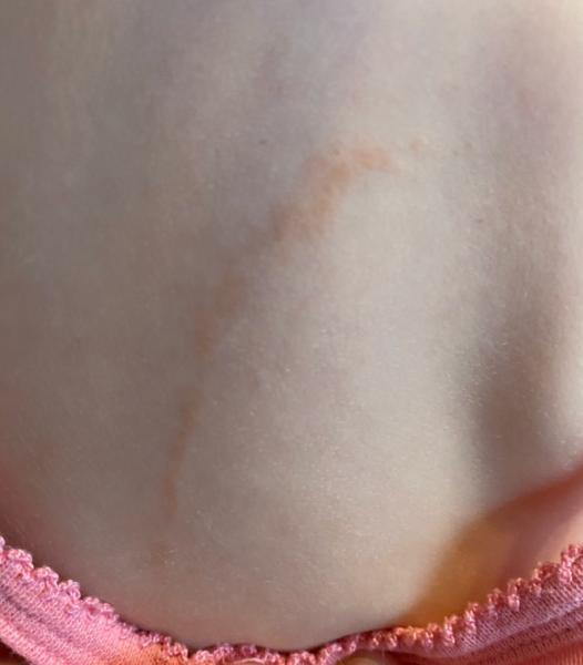 Bild zu Hautveränderung Rücken - Baby Forum - Allgemeine Themen