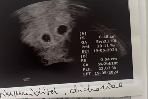 Bild zu 7 schwangerschaftswoche + Endometriose leere fruchthüllen. - Baby Forum - Allgemeine Themen