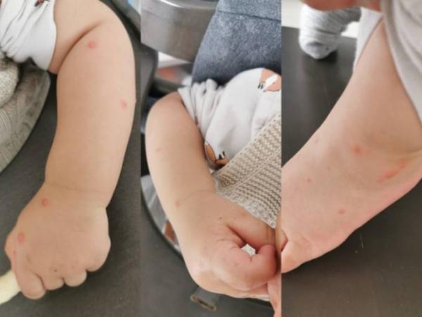 Bild zu Was kann das sein? Pickel? - Baby Forum - Allgemeine Themen