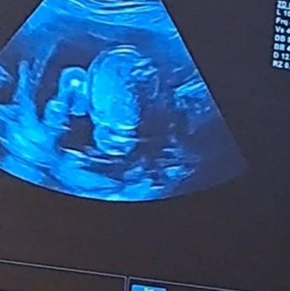 Bild zu Mädchen oder Junge - Baby Forum - Allgemeine Themen