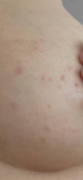 Bild zu Ausschlag Brust/ Abpumpen - Baby Forum - Allgemeine Themen