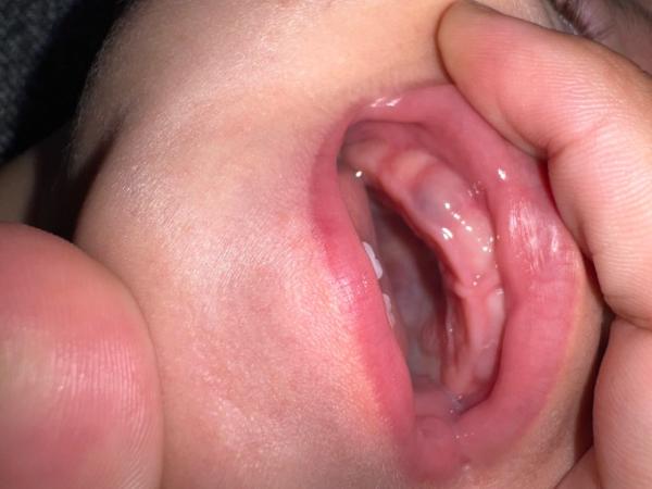 Bild zu Zahnfleisch bei Baby blau - Baby Forum - Allgemeine Themen