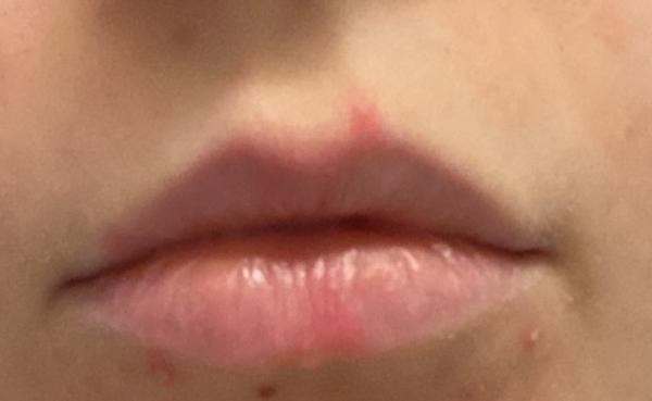 Bild zu Herpes? - Baby Forum - Allgemeine Themen